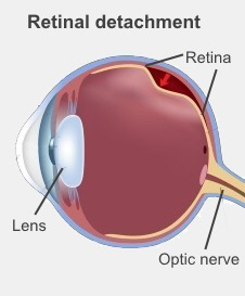 Medical illustration that shows the retina detached from the eye.