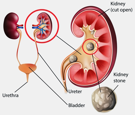 Anatomic illustration of a kidney stone within a cutaway view of the kidney and ureter