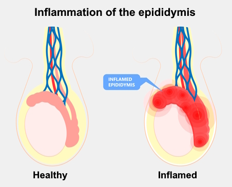 Anatomic illustration showing the testicle and inflammation of the epididymis